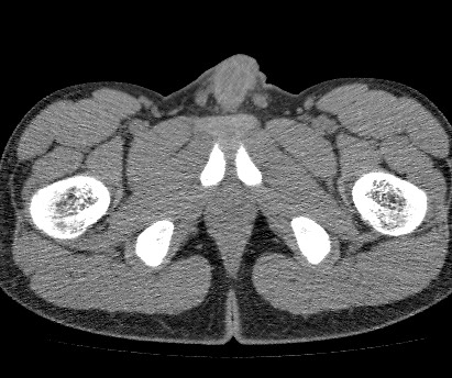 Anterior inferior iliac spine avulsion fracture (Radiopaedia 81312-94999 Axial non-contrast 68).jpg