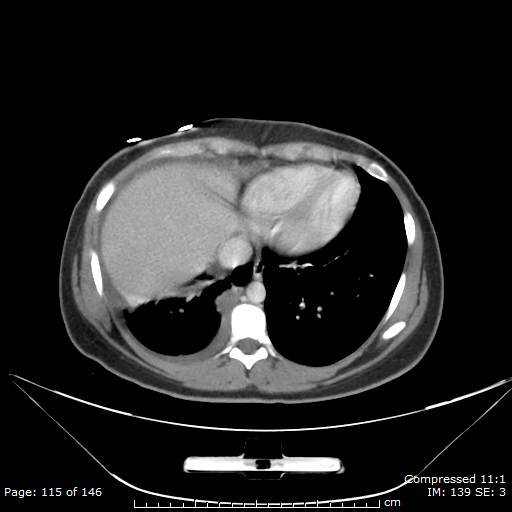 Anterior mediastinal B cell Lymphoma (Radiopaedia 50677-56114 A 58).jpg