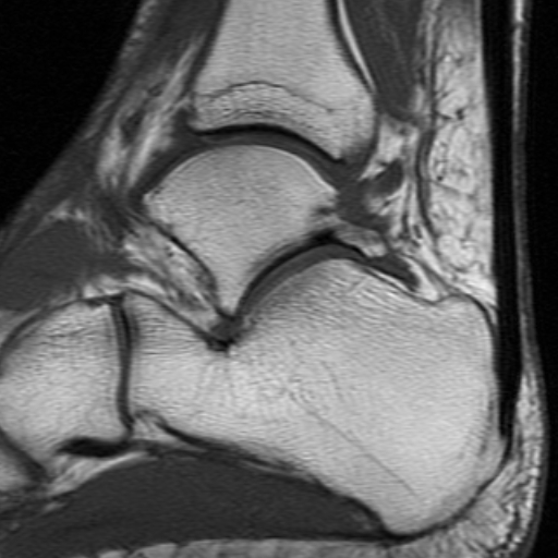 File:Anterior talofibular ligament rupture (Radiopaedia 15831-15484 Sagittal T1 8).jpg