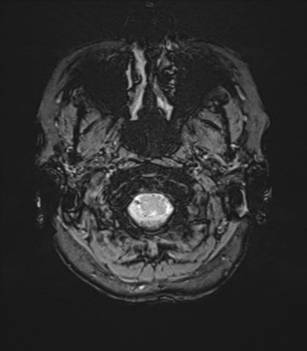 Anterior temporal lobe perivascular space (Radiopaedia 40946-43650 Axial SWI 4).png