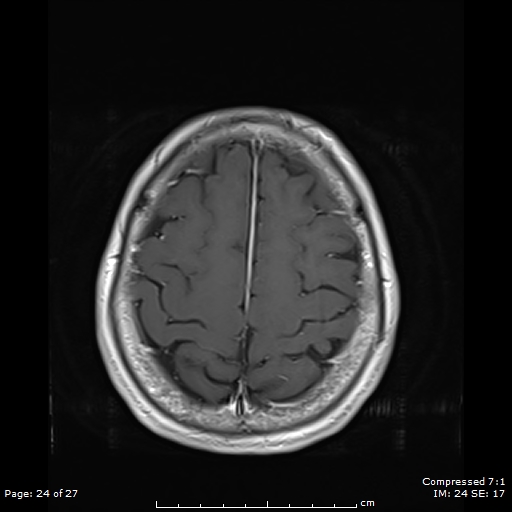 File:Anterior temporal lobe perivascular space (Radiopaedia 88283-104914 Axial T1 C+ 24).jpg