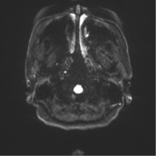 Anterior temporal pole cysts (Radiopaedia 46629-51102 Axial DWI 29).png