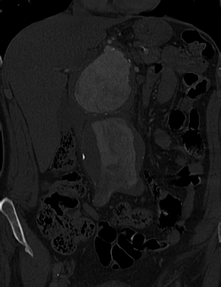 Anterior vertebral scalloping (abdominal aortic aneurysm) (Radiopaedia 66744-76067 Coronal bone window 6).jpg