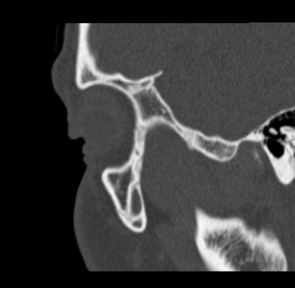 Antrochoanal polyp (Radiopaedia 33984-35202 Sagittal bone window 3).jpg