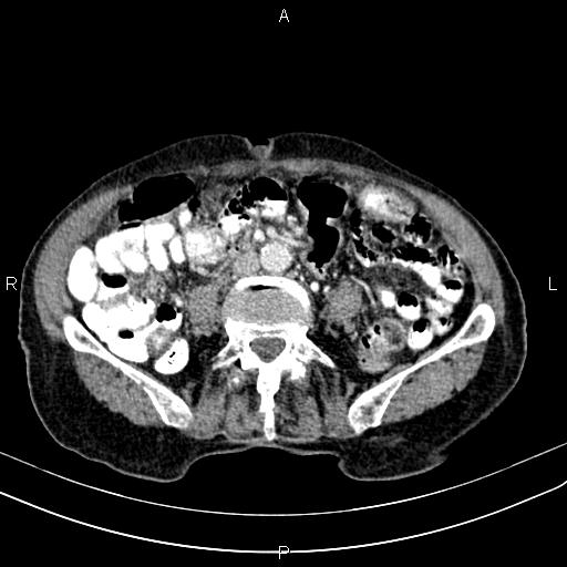 File:Aortic aneurysm and Lemmel syndrome (Radiopaedia 86499-102554 A 49).jpg