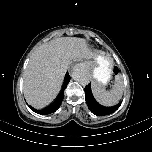 Aortic aneurysm and Lemmel syndrome (Radiopaedia 86499-102554 Axial C+ delayed 13).jpg
