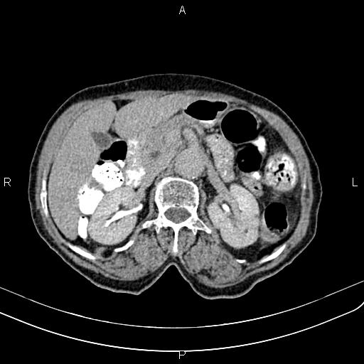 Aortic aneurysm and Lemmel syndrome (Radiopaedia 86499-102554 Axial C+ delayed 29).jpg