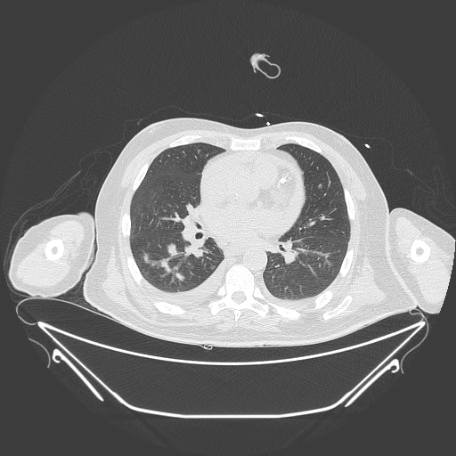 Aortic arch aneurysm (Radiopaedia 84109-99365 Axial lung window 153).jpg