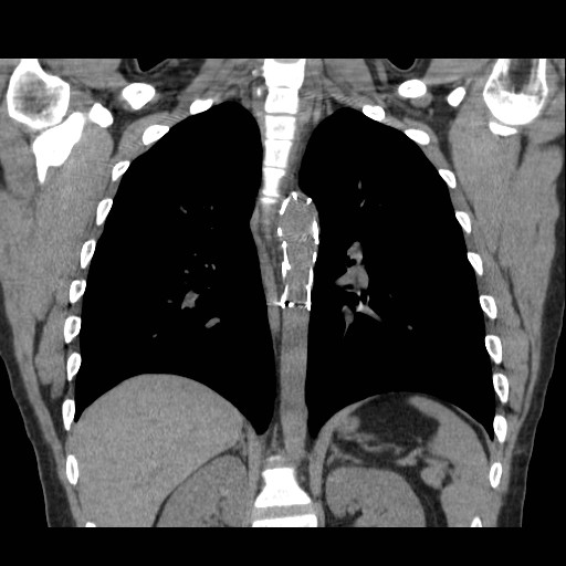 File:Aortic arch stent (Radiopaedia 30030-30595 Coronal non-contrast 19).jpg