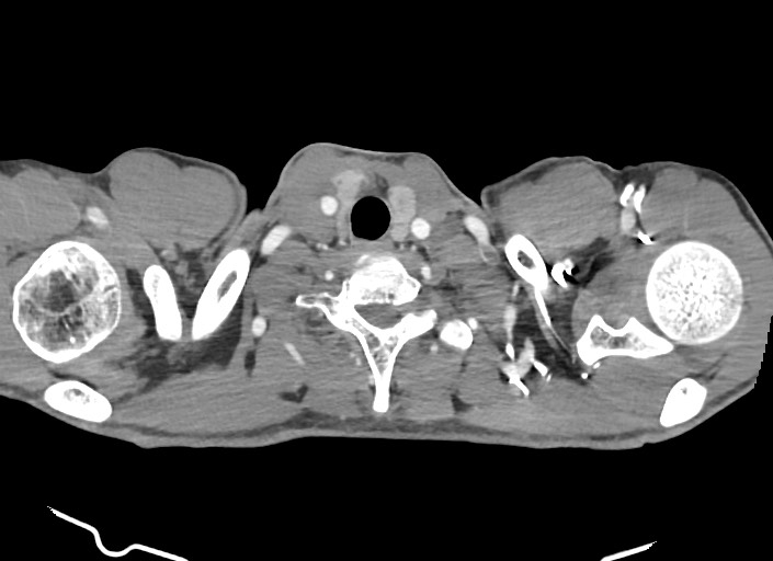 File:Aortic coarctation with aneurysm (Radiopaedia 74818-85828 A 187).jpg
