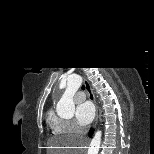 File:Aortic dissection- Stanford A (Radiopaedia 35729-37268 D 27).jpg