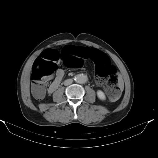 File:Aortic dissection- Stanford type A (Radiopaedia 22085-22085 Axial C+ delayed 29).jpg