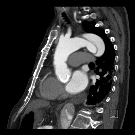 Aortic dissection (CTPA) (Radiopaedia 75506-86750 C 61).jpg