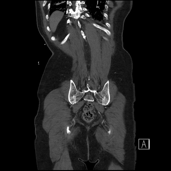 File:Aortic dissection (CTPA) (Radiopaedia 75506-86750 F 66).jpg
