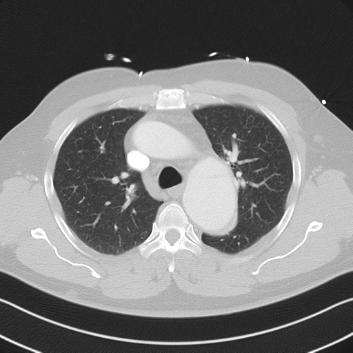 File:Aortic dissection (Radiopaedia 50763-56234 Axial lung window 26).png