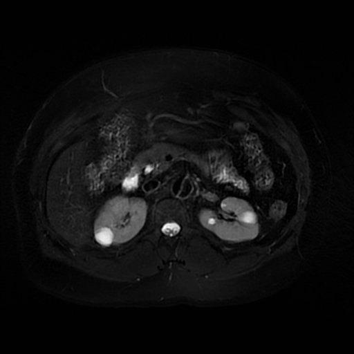File:Aortic dissection (Radiopaedia 57969-64956 Axial T2 fat sat 29).jpg