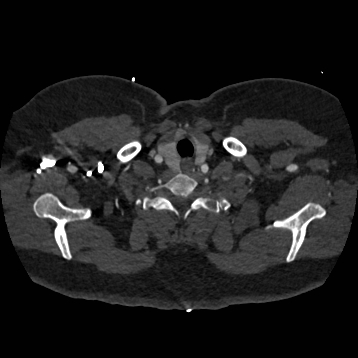 Aortic dissection (Radiopaedia 57969-64959 A 18).jpg
