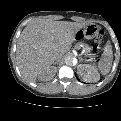 File:Aortic dissection - Stanford A -DeBakey I (Radiopaedia 28339-28587 B 107).jpg