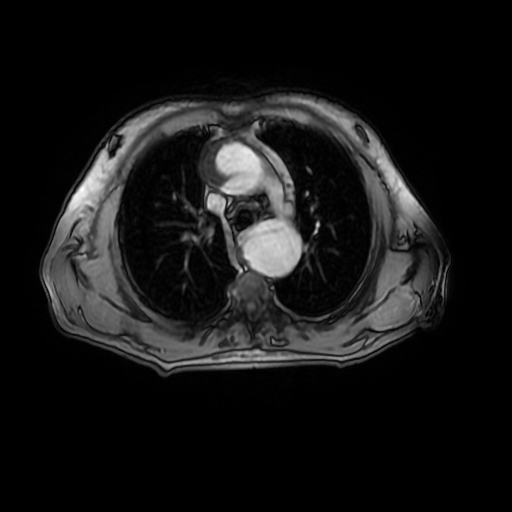 File:Aortic dissection - Stanford A - DeBakey I (Radiopaedia 23469-23551 Axial MRA 11).jpg