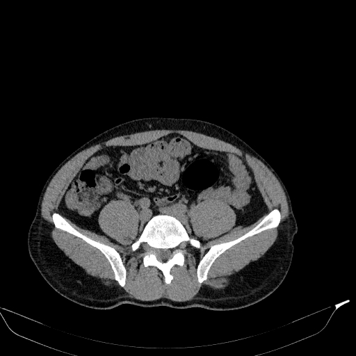 Aortic dissection - Stanford type A (Radiopaedia 83418-98500 Axial non-contrast 70).jpg