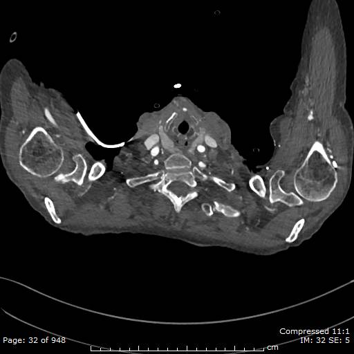 File:Aortic dissection with extension into aortic arch branches (Radiopaedia 64402-73204 B 32).jpg