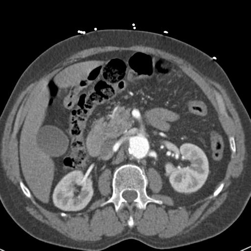 Aortic intramural hematoma (Radiopaedia 31139-31838 B 98).jpg