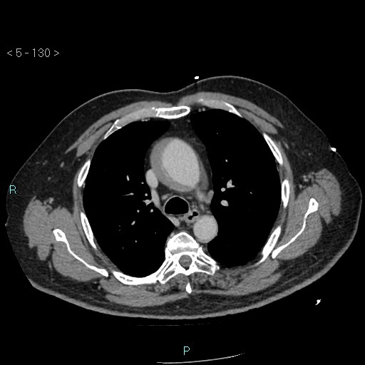 File:Aortic intramural hematoma (Radiopaedia 48463-53380 C 60).jpg