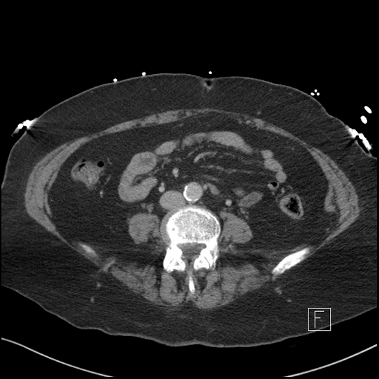 File:Aortic intramural hematoma with dissection and intramural blood pool (Radiopaedia 77373-89491 E 54).jpg
