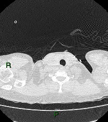 File:Aortic valve endocarditis (Radiopaedia 87209-103485 Axial lung window 5).jpg