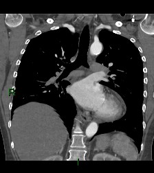 Aortic valve endocarditis (Radiopaedia 87209-103485 D 31).jpg