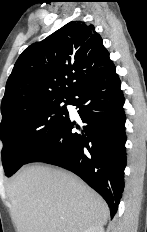 Aortic valve non-coronary cusp thrombus (Radiopaedia 55661-62189 C+ arterial phase 48).png