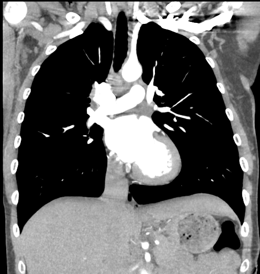File:Aortic valve non-coronary cusp thrombus (Radiopaedia 55661-62189 C 38).png