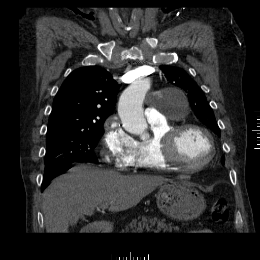 File:Aorto-coronary bypass graft aneurysms (Radiopaedia 40562-43157 B 14).png