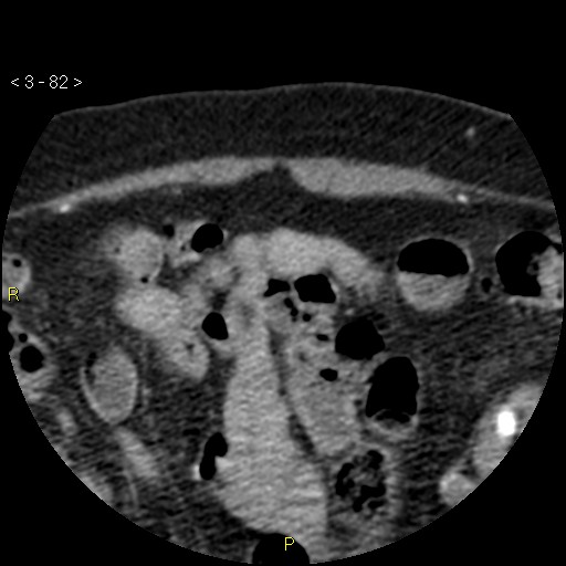 Aortoiliac occlusive disease (Radiopaedia 16828-16548 A 82).jpg