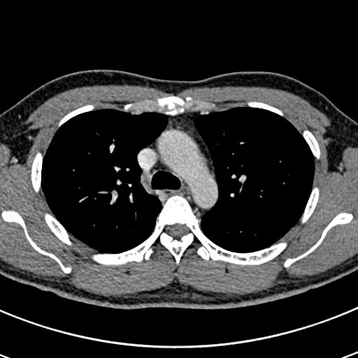 File:Apical lung mass mimic - neurogenic tumor (Radiopaedia 59918-67521 A 28).jpg