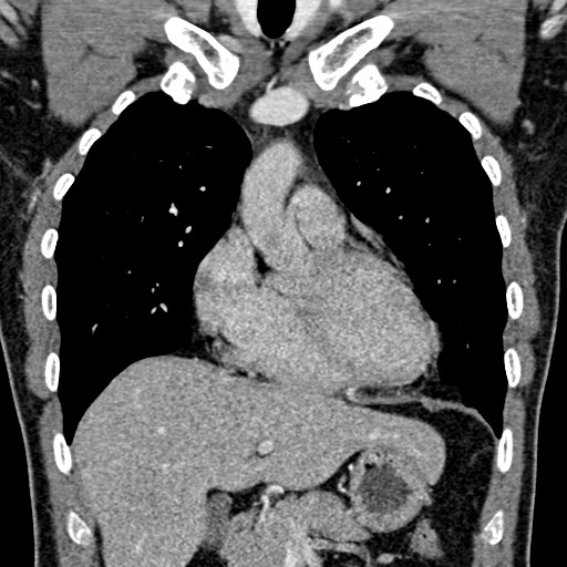 Apical lung mass mimic - neurogenic tumor (Radiopaedia 59918-67521 B 50).jpg