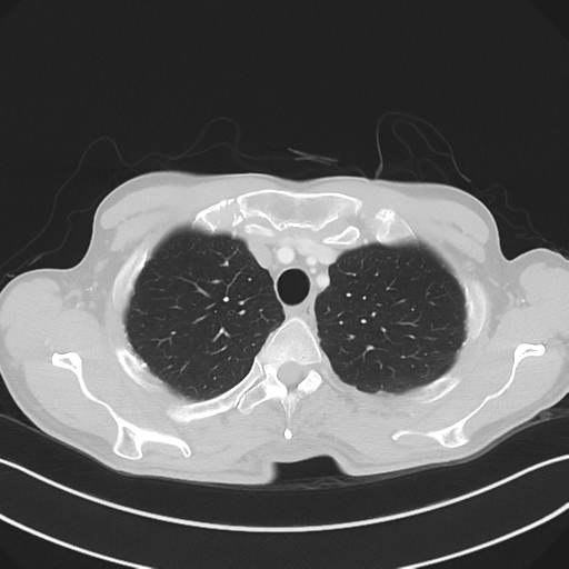 Apical pleural calcification (Radiopaedia 46141-50499 Axial lung window 15).png