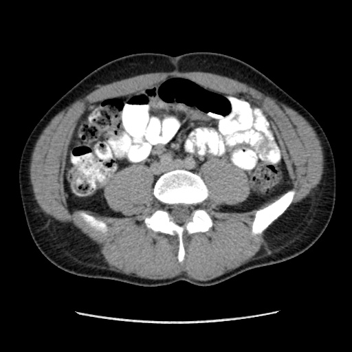 Appendicitis complicated by post-operative collection (Radiopaedia 35595-37113 A 45).jpg