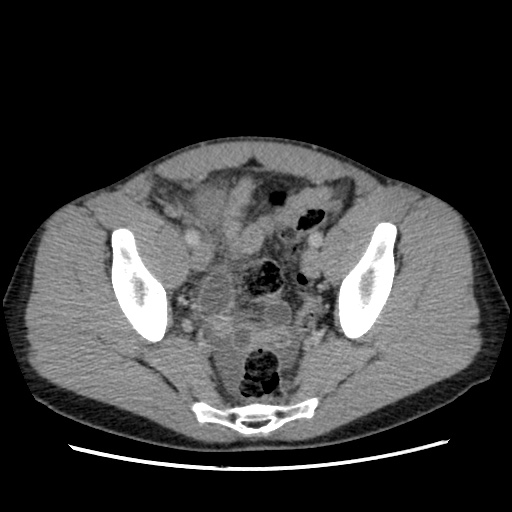File:Appendicitis complicated by post-operative collection (Radiopaedia 35595-37114 A 73).jpg