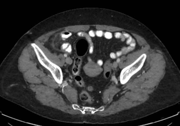 File:Appendicitis due to chicken fibula (Radiopaedia 74314-85198 A 38).jpg