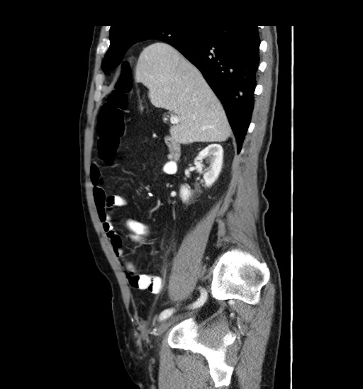 File:Appendicitis with localized perforation and abscess formation (Radiopaedia 49035-54130 C 21).jpg