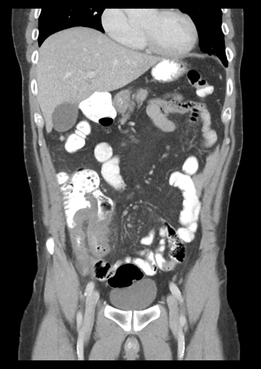 Appendicitis with thickening of the terminal ileum (Radiopaedia 42432-45550 B 20).png