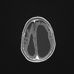 Aqueductal stenosis (Radiopaedia 73974-84802 Axial T1 C+ 119).jpg