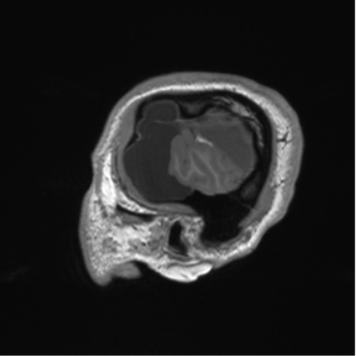 Arachnoid cyst with subdural hematoma (Radiopaedia 85892-101743 Sagittal T1 12).png