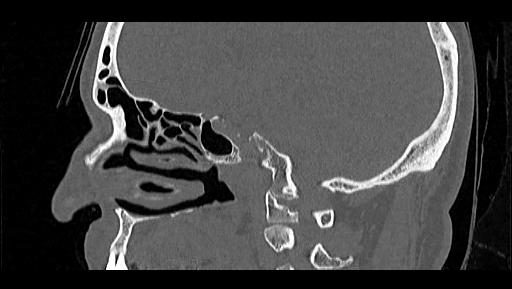 Arcuate foramen (Radiopaedia 89833-106944 Sagittal bone window 37).jpg