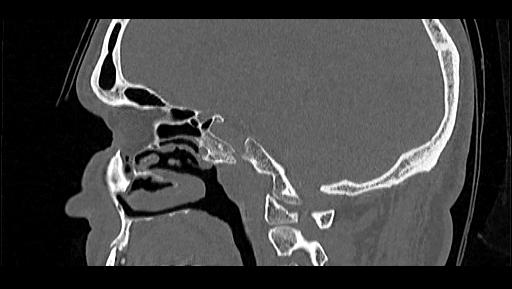 File:Arcuate foramen (Radiopaedia 89833-106944 Sagittal bone window 79).jpg