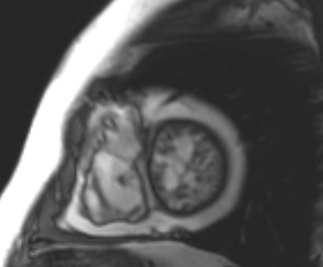 Arrhythmogenic right ventricular cardiomyopathy (Radiopaedia 69431-79307 Short axis cine 55).jpg