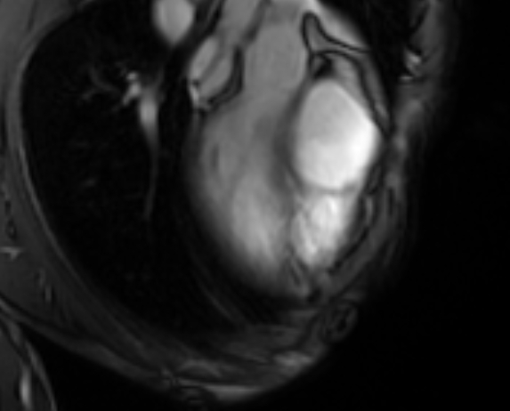 Arrhythmogenic right ventricular cardiomyopathy (Radiopaedia 69564-79464 4ch cine 13).jpg