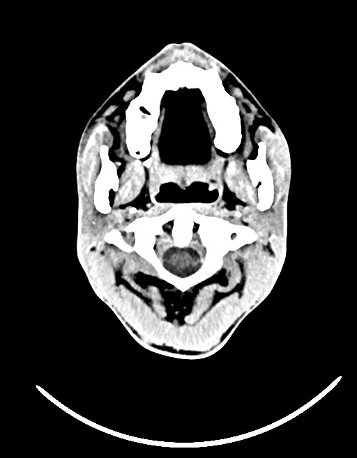 Arrow injury to the brain (Radiopaedia 72101-82607 Axial non-contrast 45).jpg