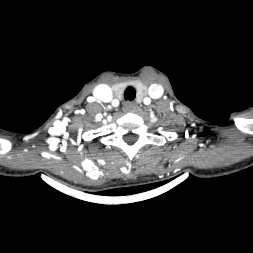 Arteriovenous malformation of the neck (Radiopaedia 53935-60062 A 10).jpg